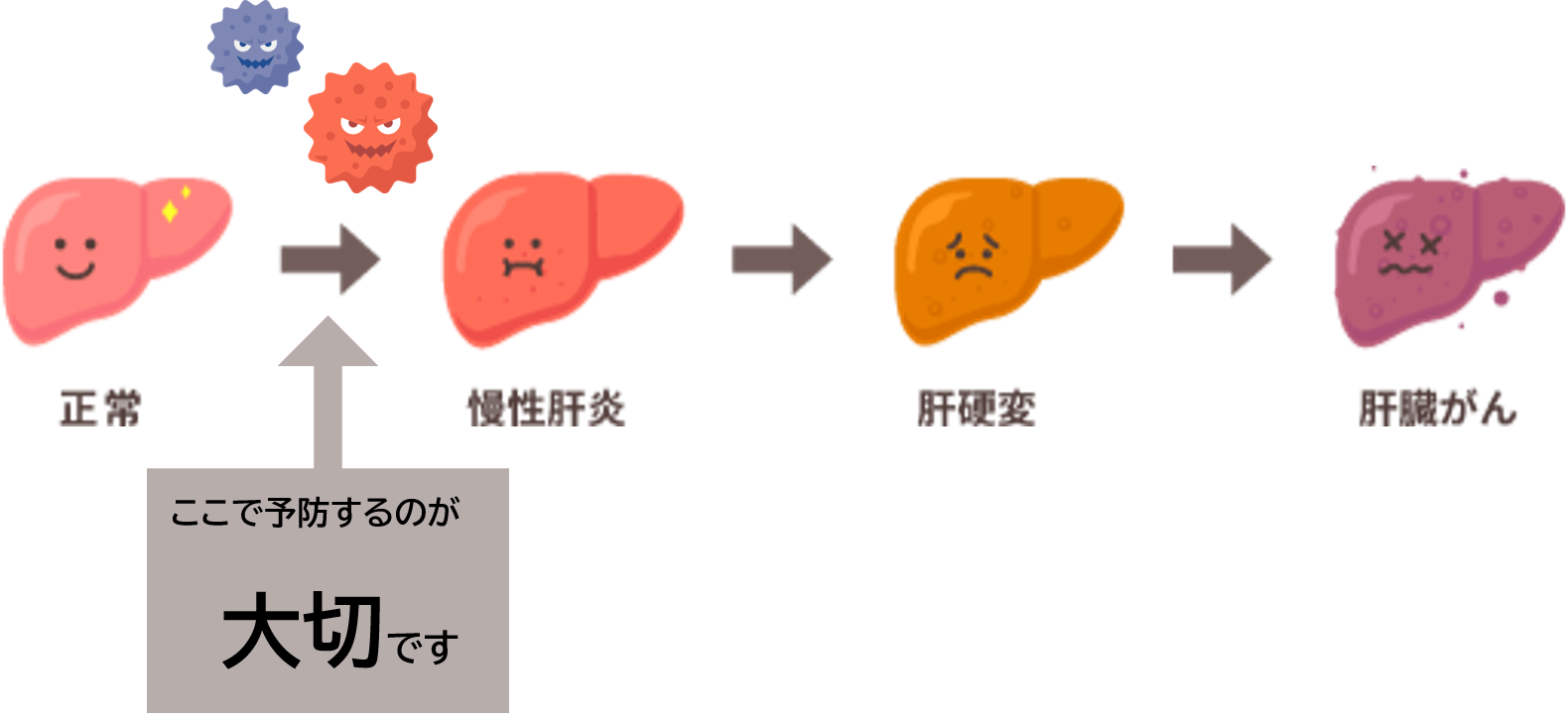 肝臓が正常な状態から、慢性肝炎になり、肝硬変になり、最終的に肝臓がんになる様子を表したイラストです。